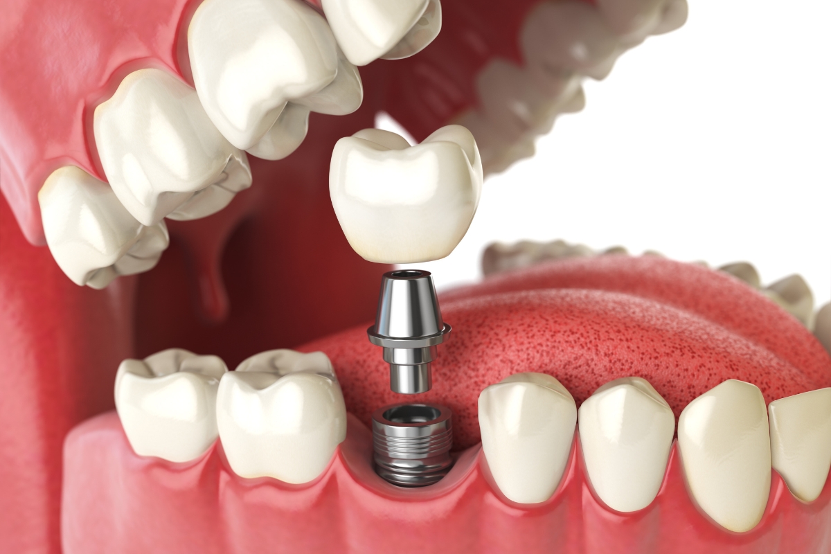 Dental Implants: Stop Bone Loss & Restore Your Smile
