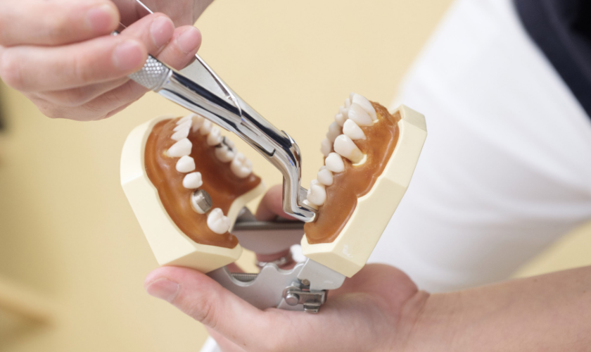Wisdom Teeth Removal: A Must