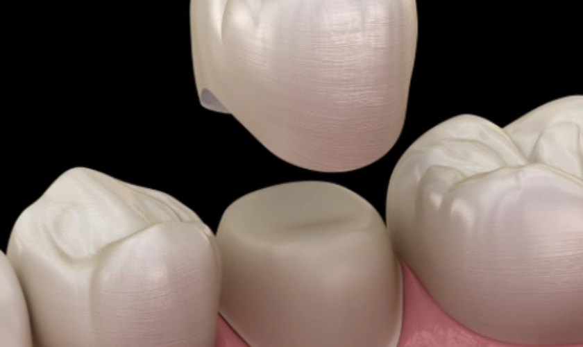 Do You Need a Dental Crown? West Jordan's Guide