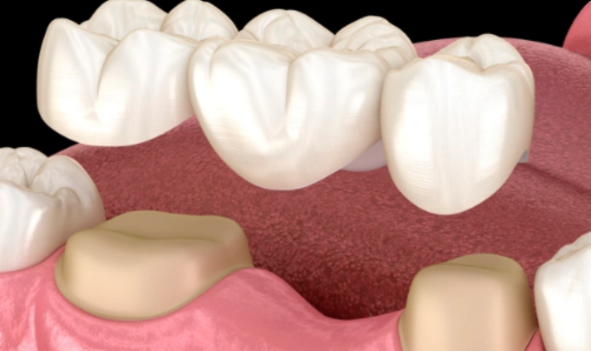 Restoring Your Smile with Dental Bridges in West Jordan