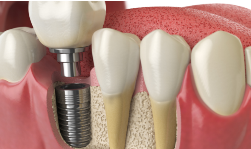 Why Titanium is Ideal for Successful Dental Implants