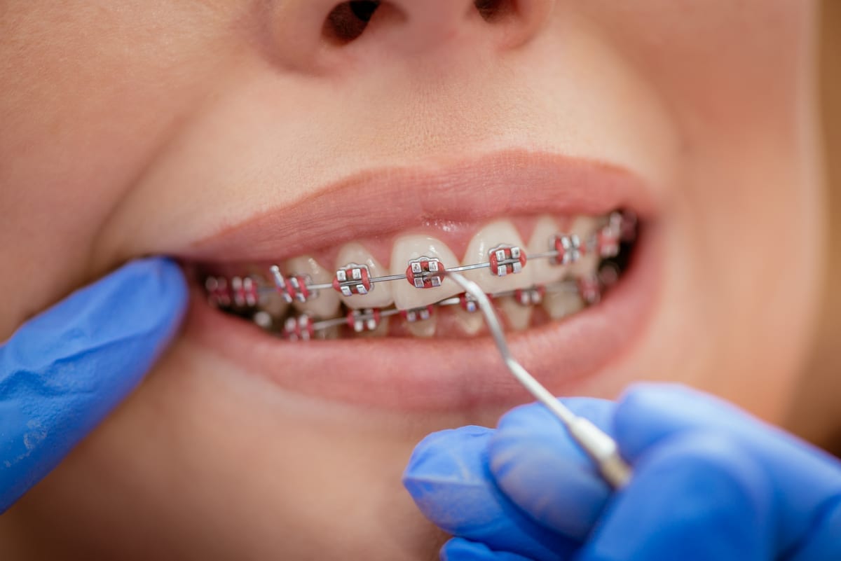 Tooth-Colored Fillings: 5 Questions Patients Always Ask First